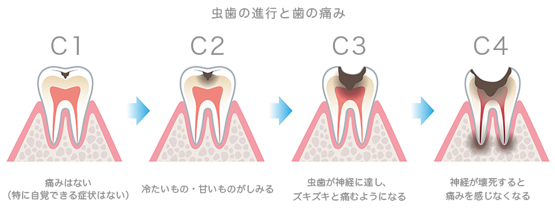虫歯の進行と歯の痛み