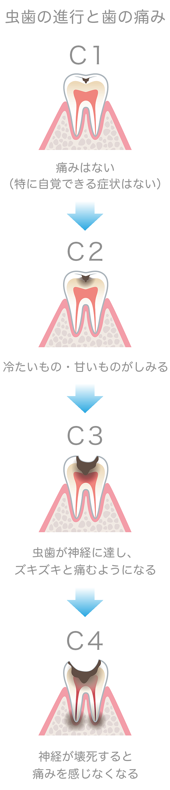 虫歯の進行と歯の痛み