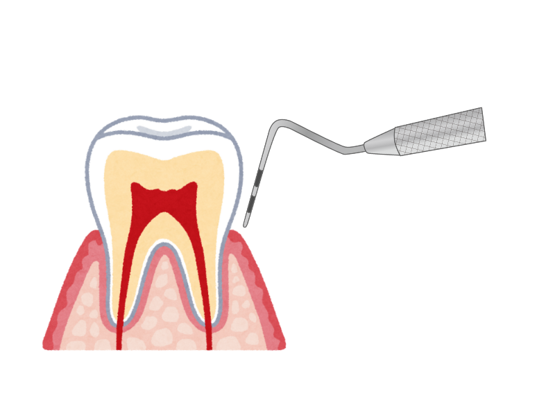 歯周ポケット検査