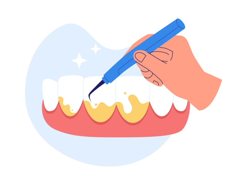 スケーリング（歯石除去）