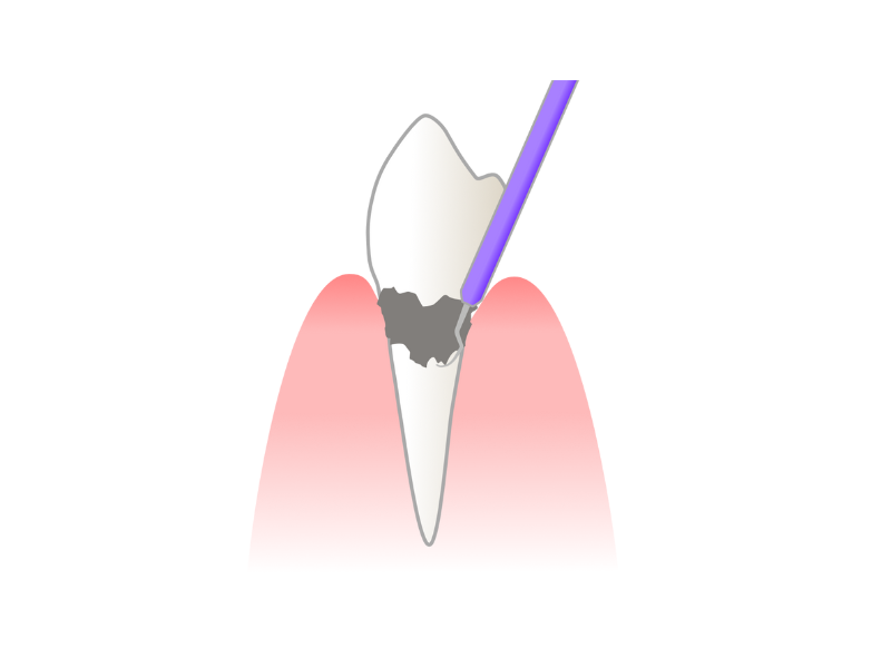 スケーリング（歯石除去）